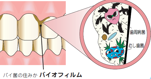 バイオフィルムをご存知ですか　～　北浦和 よしはら歯科クリニック