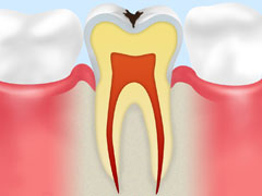 エナメル質の虫歯（C1）
