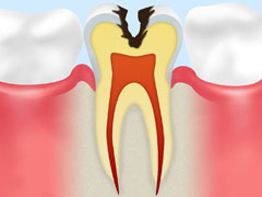 象牙質の虫歯（C2）