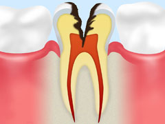 神経の虫歯（C3）