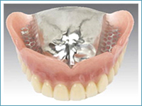 金属床の入れ歯