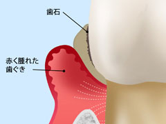 STEP2　中等度歯周病