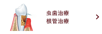 虫歯治療 根管治療