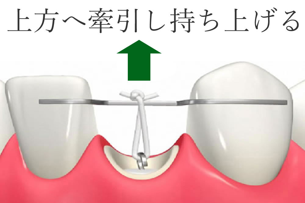 エクストルージョン(歯根挺出)