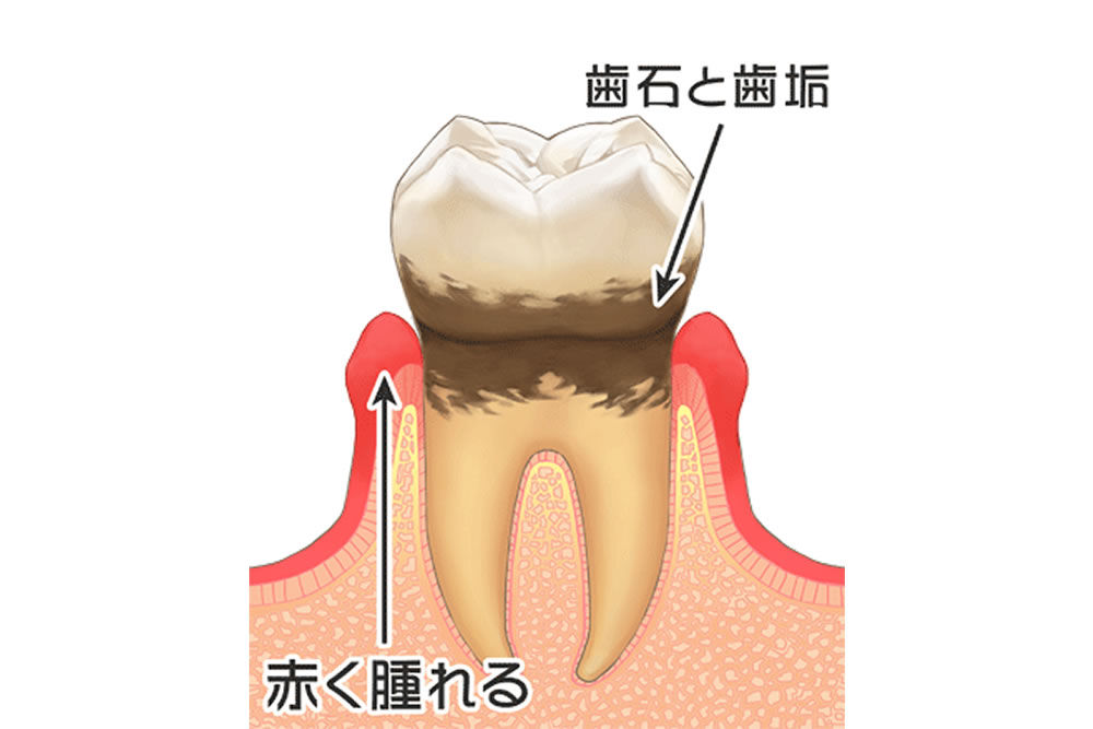 歯肉炎(軽度の歯周病)