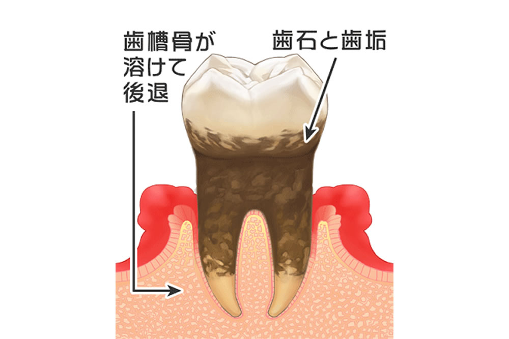 歯周炎(中度~重度の歯周病)